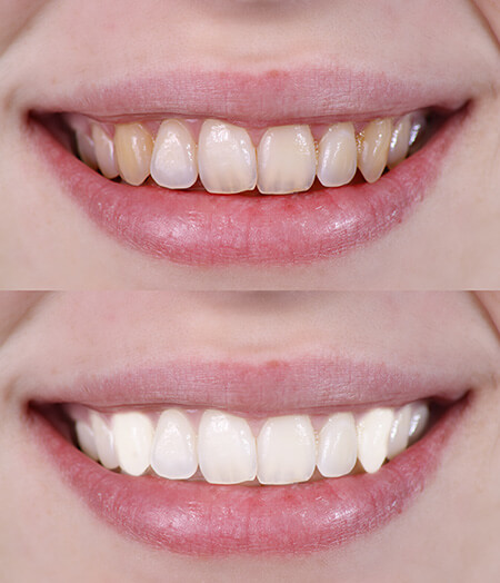 Ogden, Utah dentist smile gallery 01 Ogden, Utah dentist smile gallery 01