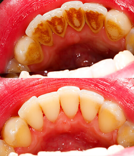 Ogden, Utah dentist smile gallery 03 Ogden, Utah dentist smile gallery 03