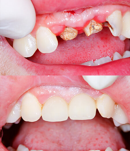Ogden, Utah dentist smile gallery 04 Ogden, Utah dentist smile gallery 04