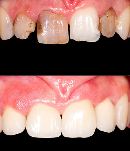Ogden, Utah dentist smile gallery 06 Ogden, Utah dentist smile gallery 06