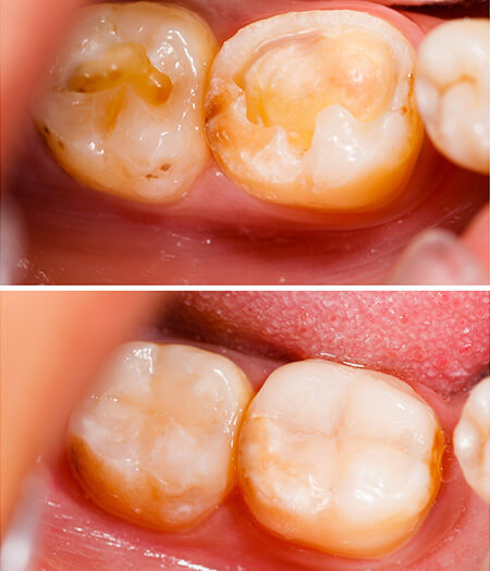 Ogden, Utah dentist smile gallery 07 Ogden, Utah dentist smile gallery 07
