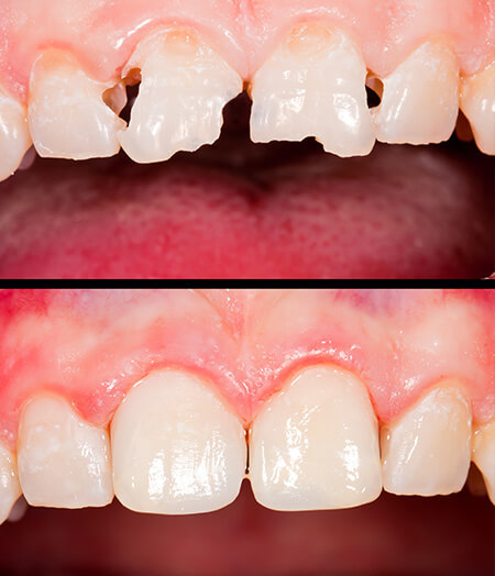 Ogden, Utah dentist smile gallery 10 Ogden, Utah dentist smile gallery 10