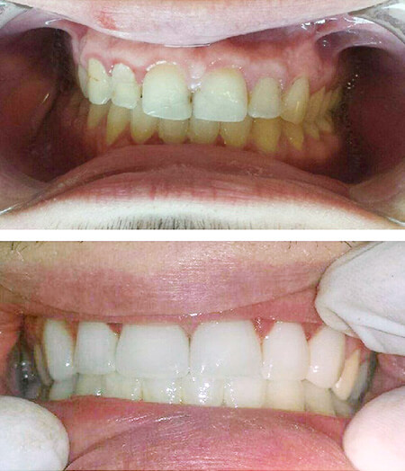 Ogden, Utah dentist smile gallery 11 Ogden, Utah dentist smile gallery 11