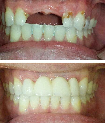 Ogden, Utah dentist smile gallery 12 Ogden, Utah dentist smile gallery 12